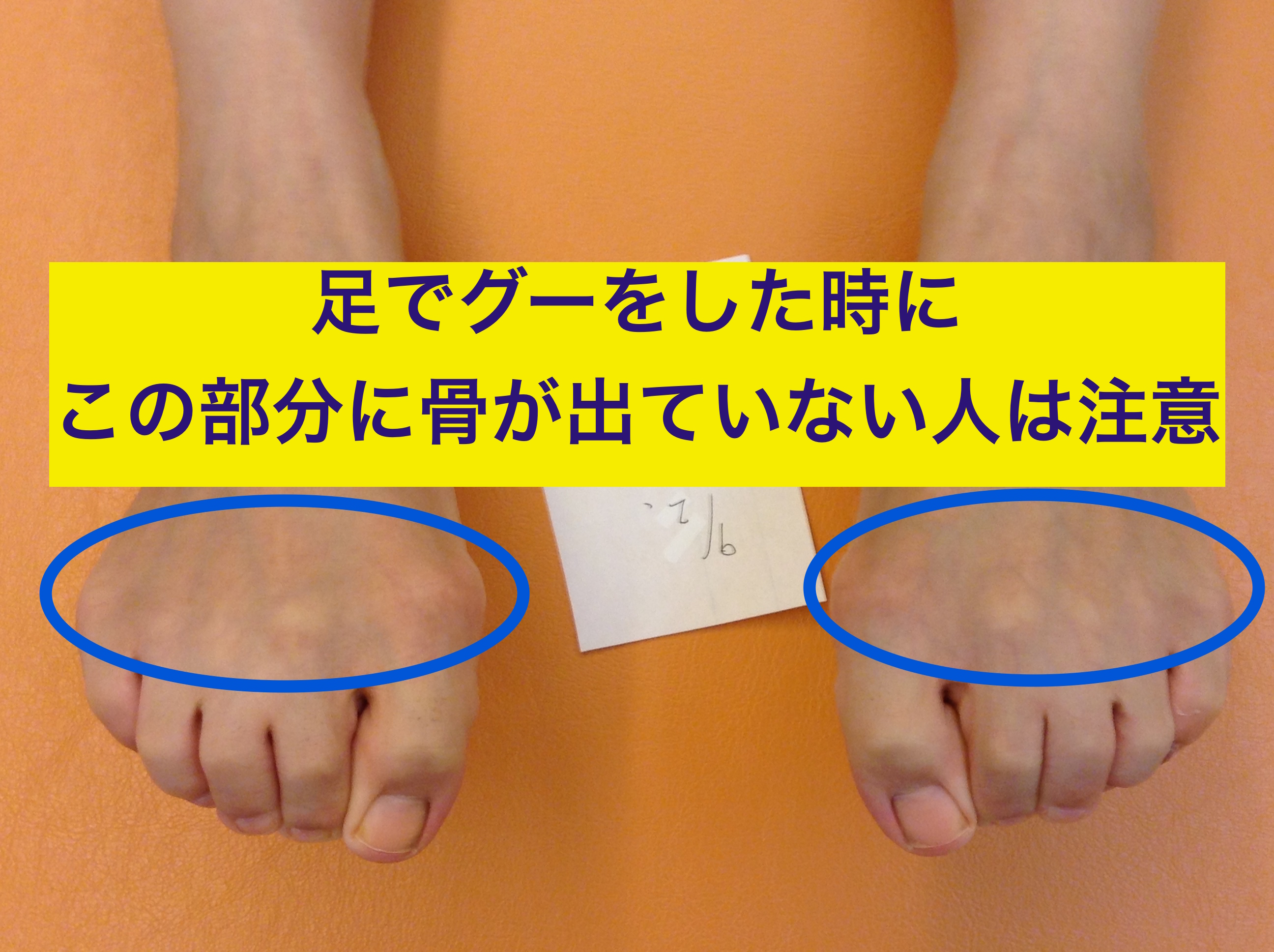 市場 外反拇趾 足指セパレーター つち状足指 6個入り 足指痛み 足指変形 浮指